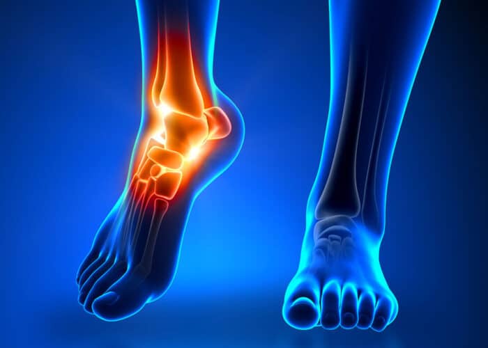 Ankle Pain